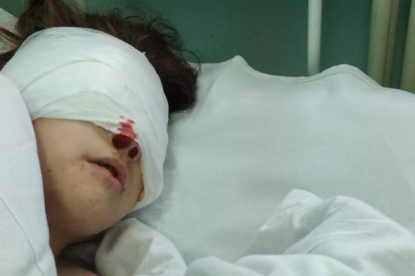 В Тверской области овчарка покусала лицо 10-летней девочке В Тверской области овчарка покусала лицо 10-летней девочке